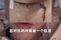 雷速体育官网首页-球星重伤需紧急动手术救治的简单介绍